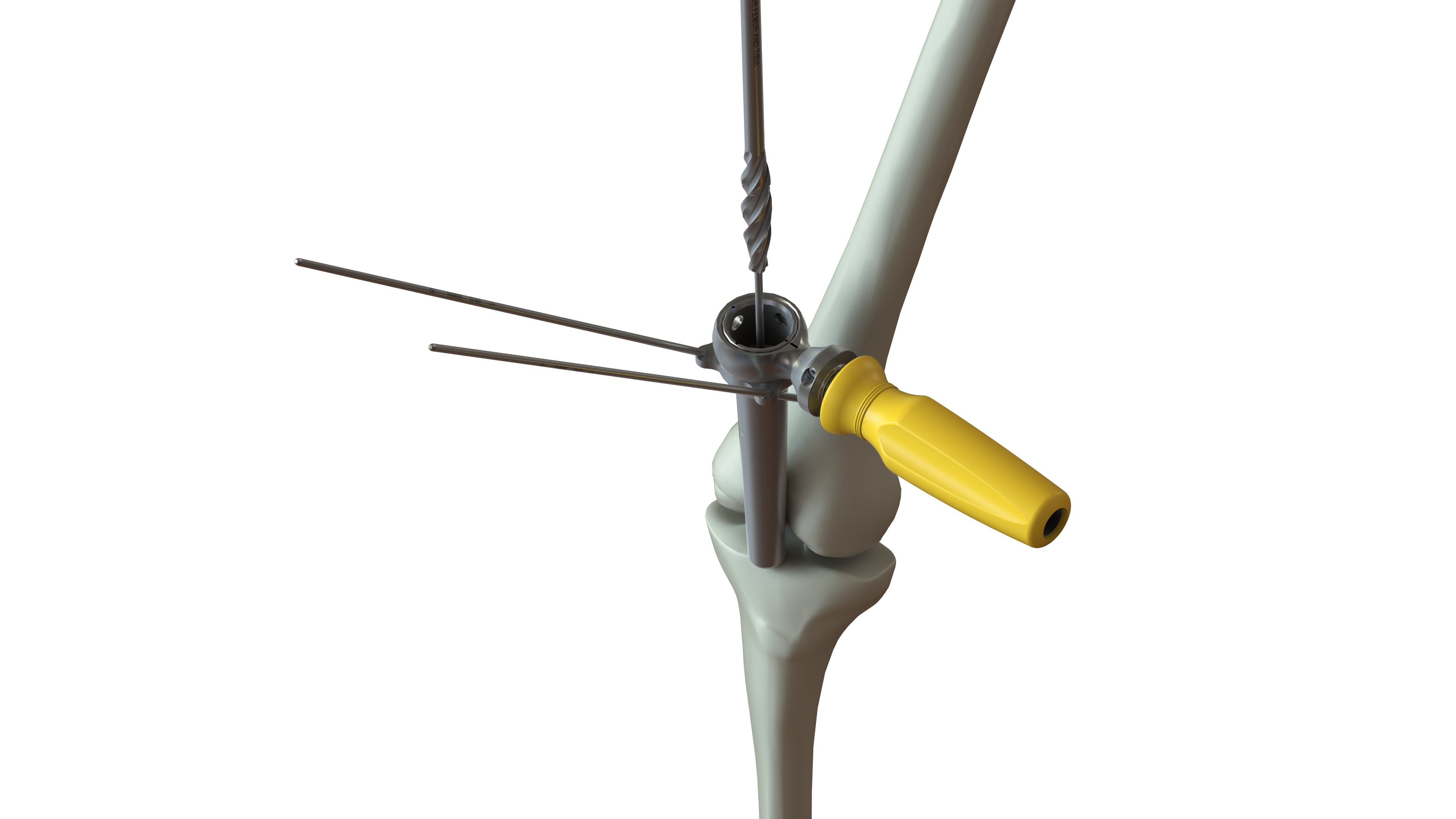 Semi-Extended Tibia Nail Instrumentation